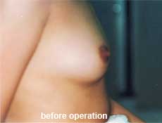 plastic-surgery-breast-augmentation 